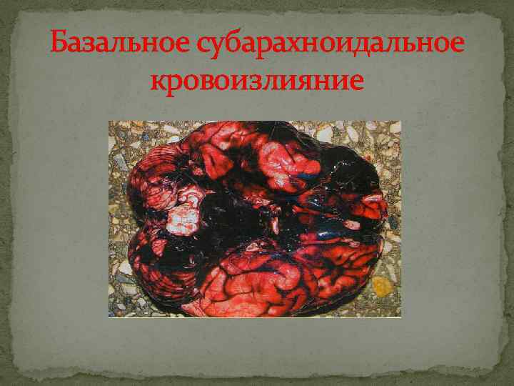 Базальное субарахноидальное кровоизлияние 