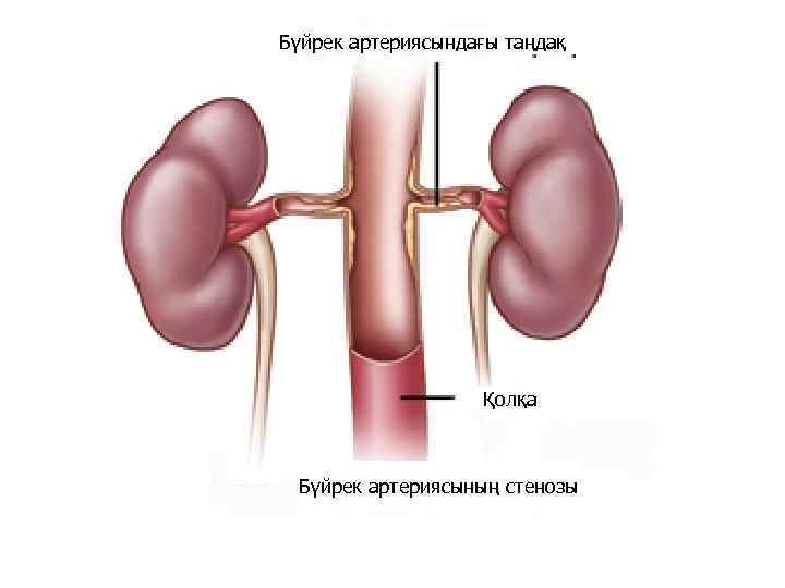 Бүйрек артериясындағы таңдақ Қолқа Бүйрек артериясының стенозы 