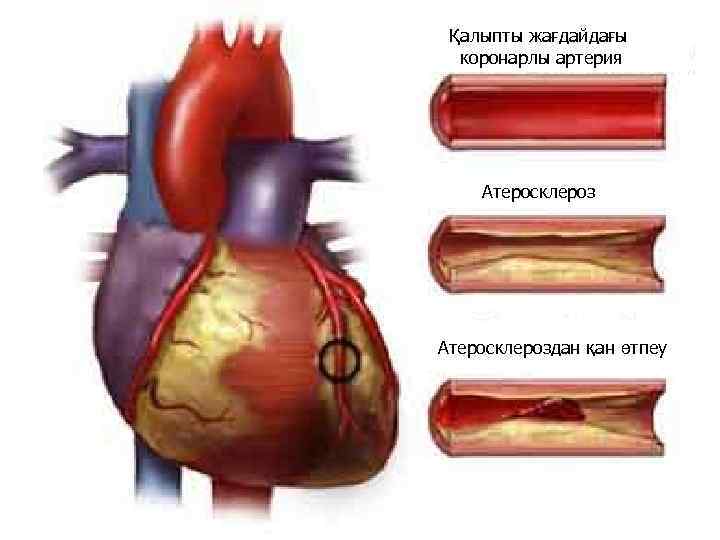 Қалыпты жағдайдағы коронарлы артерия Атеросклероздан қан өтпеу 