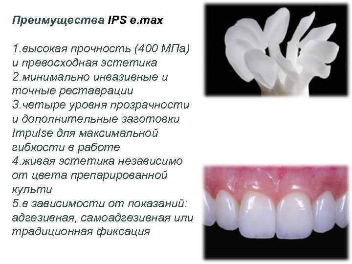 Преимущества IPS e. max 1. высокая прочность (400 МПа) и превосходная эстетика 2. минимально