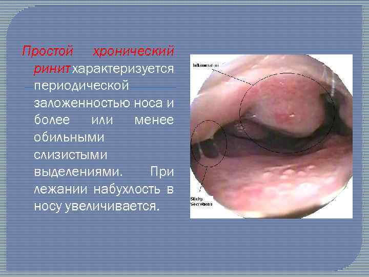 Простой хронический ринит характеризуется периодической заложенностью носа и более или менее обильными слизистыми выделениями.