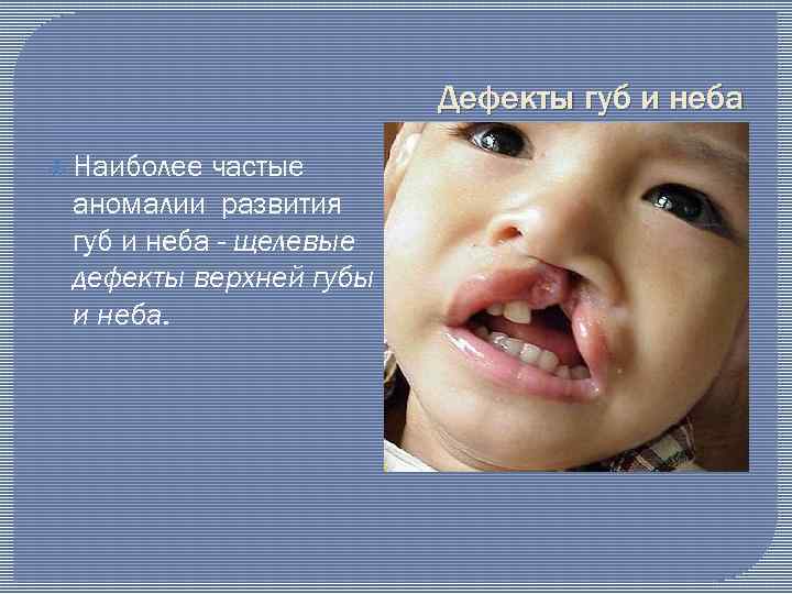 Дефекты губ и неба Наиболее частые аномалии развития губ и неба - щелевые дефекты