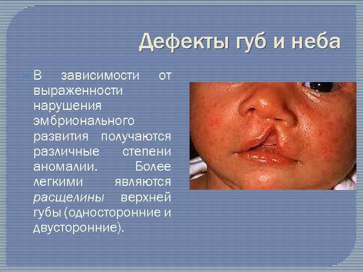 Дефекты губ и неба В зависимости от выраженности нарушения эмбрионального развития получаются различные степени