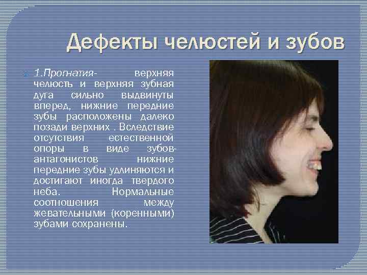 Дефекты челюстей и зубов 1. Прогнатияверхняя челюсть и верхняя зубная дуга сильно выдвинуты вперед,