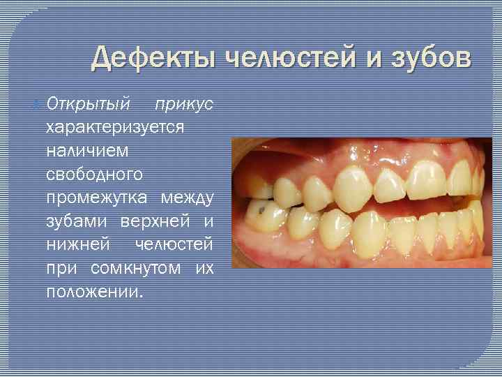 Дефекты челюстей и зубов Открытый прикус характеризуется наличием свободного промежутка между зубами верхней и