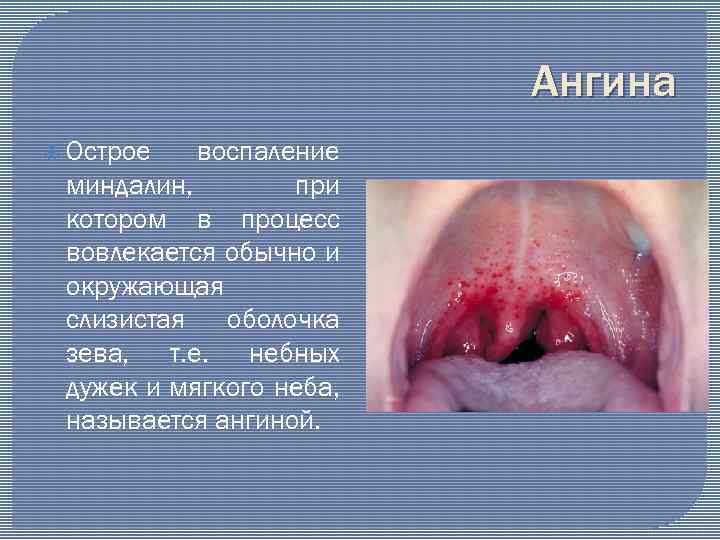 Ангина Острое воспаление миндалин, при котором в процесс вовлекается обычно и окружающая слизистая оболочка