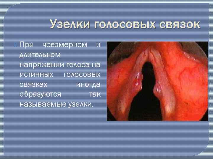 Узелки голосовых связок При чрезмерном и длительном напряжении голоса на истинных голосовых связках иногда
