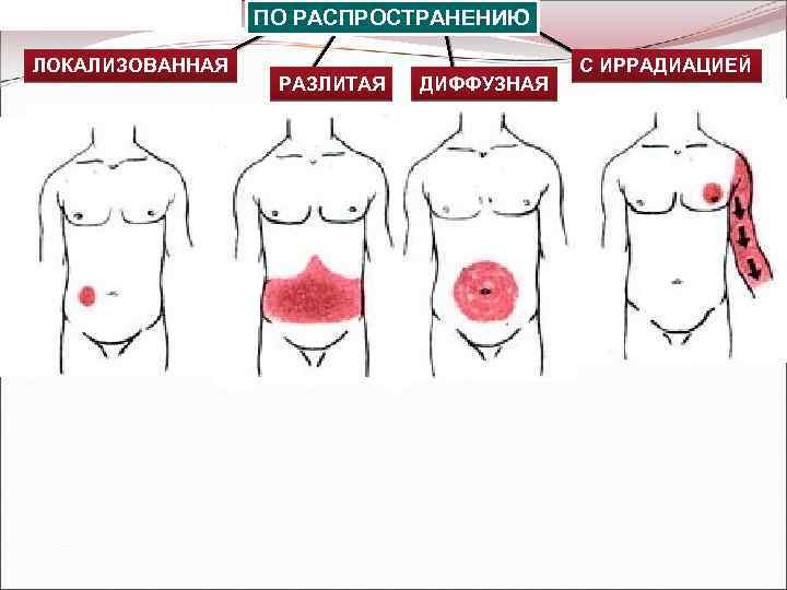 КЛАССИФИКАЦИИ БОЛИ: ЛОКАЛИЗОВАННАЯ ПО РАСПРОСТРАНЕНИЮ РАЗЛИТАЯ ДИФФУЗНАЯ С ИРРАДИАЦИЕЙ 