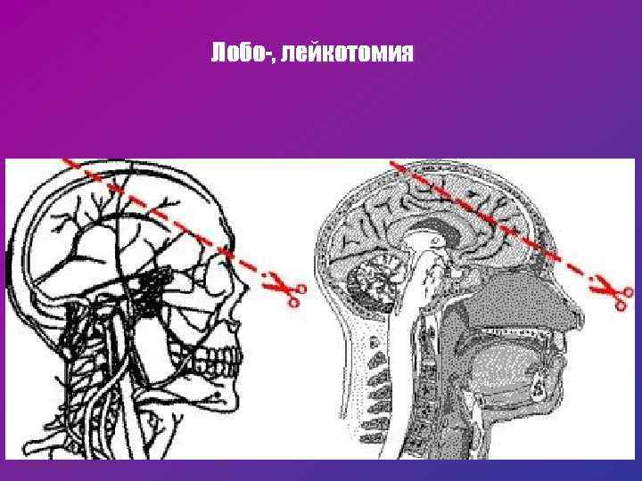 Лобо-, лейкотомия 