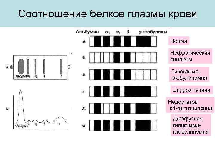 Соотношение белков плазмы крови Норма Нефротический синдром Гипогаммаглобулинемия Цирроз печени Недостаток α 1 -антитрипсина