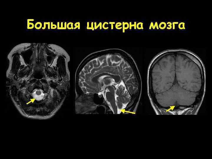 Большая цистерна мозга 