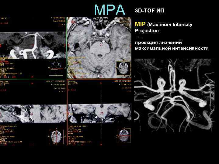 МРА 3 D-TOF ИП MIP (Maximum Intensity Projection — проекция значений максимальной интенсивности 