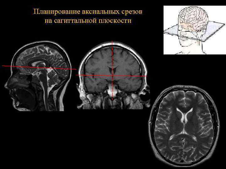 Планирование аксиальных срезов на сагиттальной плоскости 