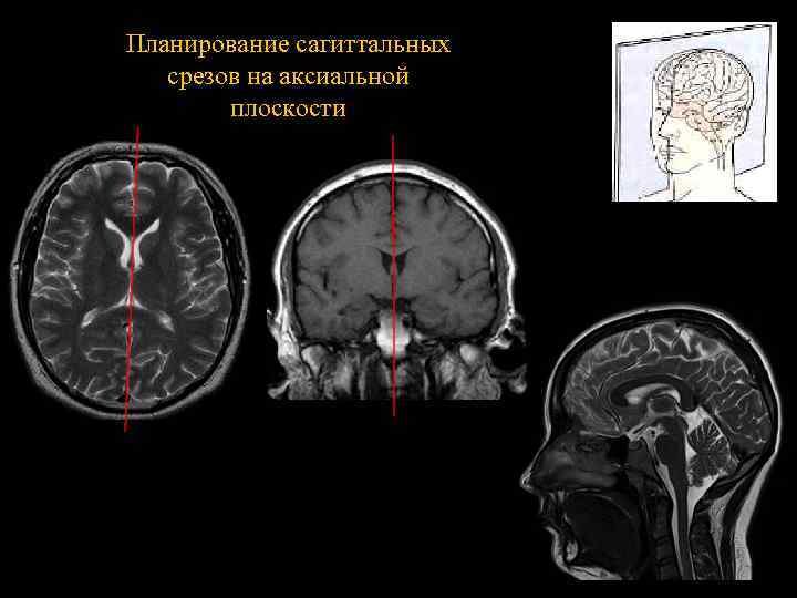 Планирование сагиттальных срезов на аксиальной плоскости 