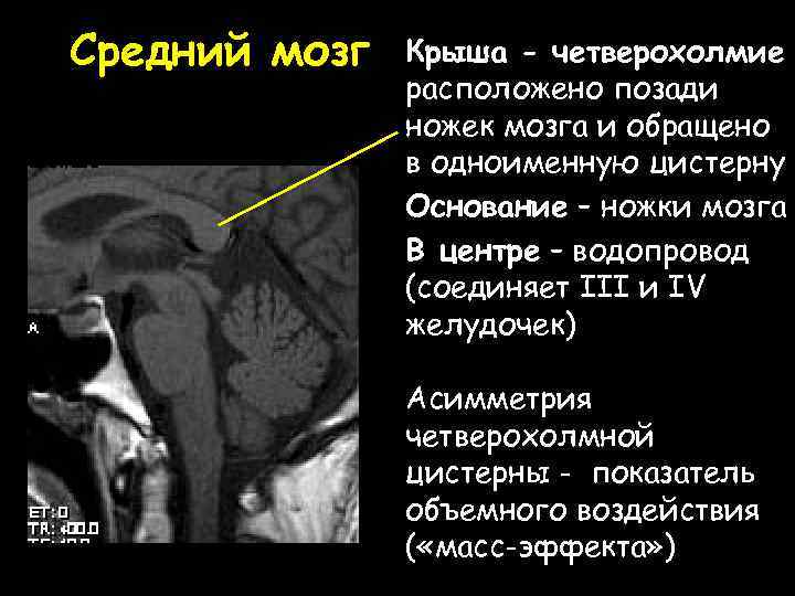 Средний мозг Крыша - четверохолмие расположено позади ножек мозга и обращено в одноименную цистерну