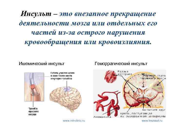 Инсульт – это внезапное прекращение деятельности мозга или отдельных его частей из-за острого нарушения