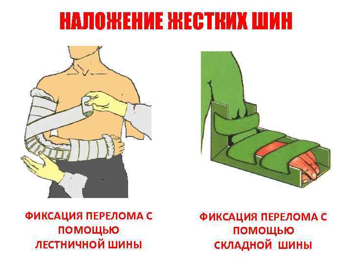 НАЛОЖЕНИЕ ЖЕСТКИХ ШИН ФИКСАЦИЯ ПЕРЕЛОМА С ПОМОЩЬЮ ЛЕСТНИЧНОЙ ШИНЫ ФИКСАЦИЯ ПЕРЕЛОМА С ПОМОЩЬЮ СКЛАДНОЙ