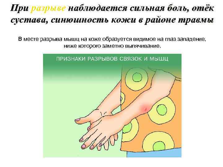 При разрыве наблюдается сильная боль, отёк сустава, синюшность кожи в районе травмы В месте