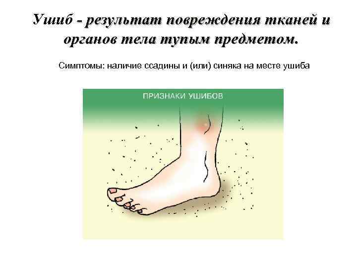 Ушиб - результат повреждения тканей и органов тела тупым предметом. Симптомы: наличие ссадины и