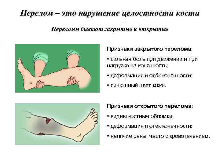 Переломы травматология презентация