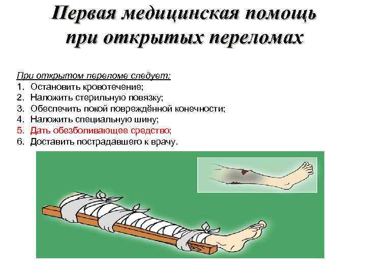 Первая медицинская помощь при открытых переломах При открытом переломе следует: 1. Остановить кровотечение; 2.