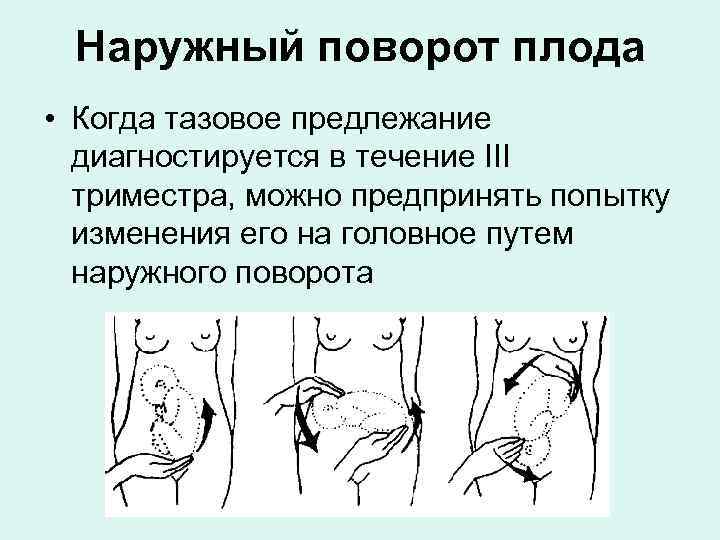 Наружный поворот плода • Когда тазовое предлежание диагностируется в течение III триместра, можно предпринять