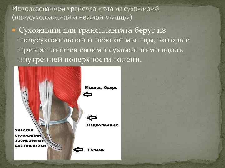 Использованием трансплантата из сухожилий (полусухожильной и нежной мышцы) Сухожилия для трансплантата берут из полусухожильной