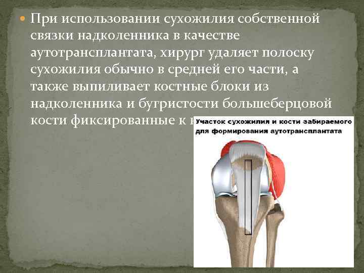  При использовании сухожилия собственной связки надколенника в качестве аутотрансплантата, хирург удаляет полоску сухожилия