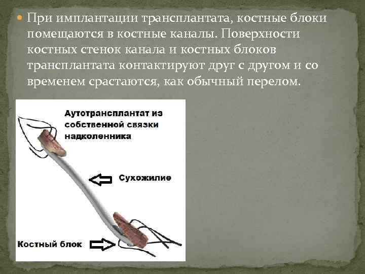  При имплантации трансплантата, костные блоки помещаются в костные каналы. Поверхности костных стенок канала