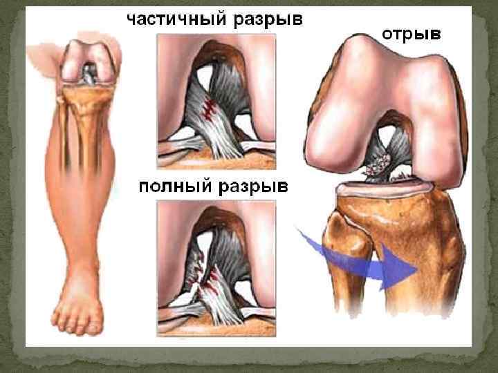 Мр картина лигаментита дистрофически измененной передней крестообразной связки