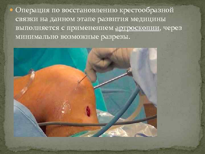  Операция по восстановлению крестообразной связки на данном этапе развития медицины выполняется с применением