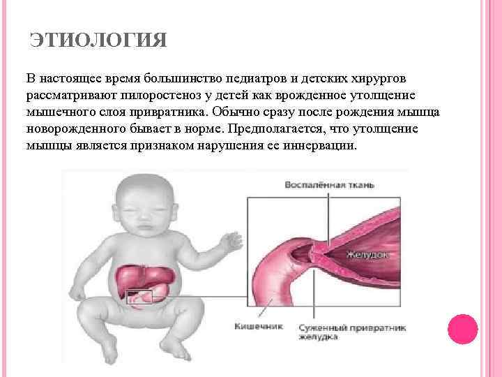 Пилоростеноз врожденный презентация