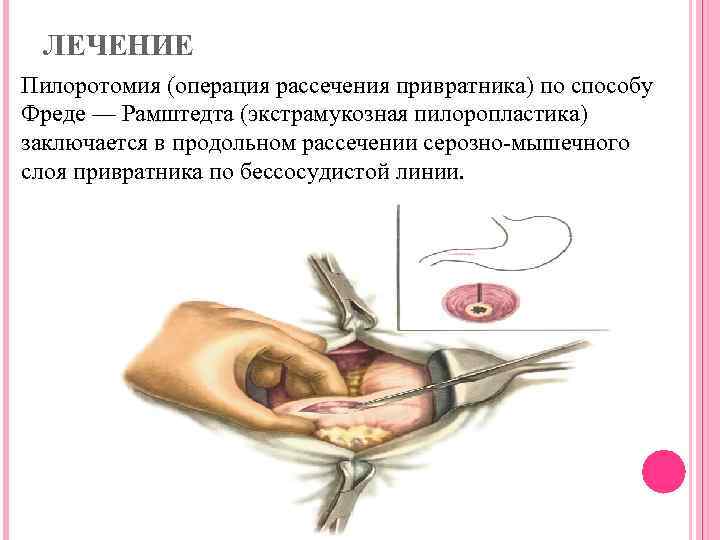 ЛЕЧЕНИЕ Пилоротомия (операция рассечения привратника) по способу Фреде — Рамштедта (экстрамукозная пилоропластика) заключается в
