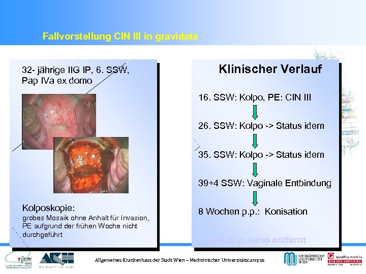 Fallvorstellung CIN III in gravidate 32 - jährige IIG IP, 6. SSW, Pap IVa