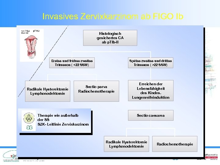 Invasives Zervixkarzinom ab FIGO Ib Histologisch gesichertes CA ab p. TIb-II Erstes und frühes