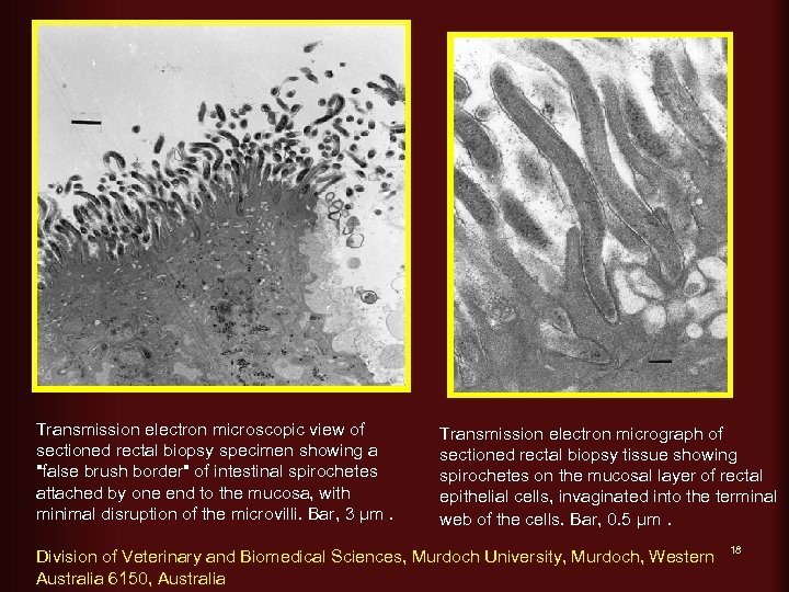 Transmission electron microscopic view of sectioned rectal biopsy specimen showing a "false brush border"