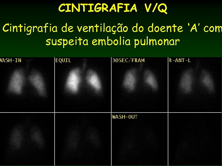 CINTIGRAFIA V/Q Cintigrafia de ventilação do doente ‘A’ com suspeita embolia pulmonar 