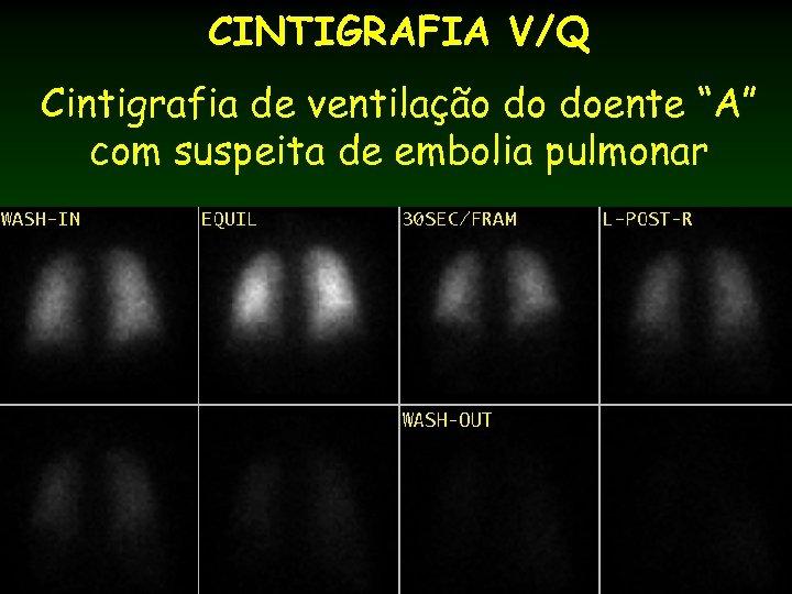 CINTIGRAFIA V/Q Cintigrafia de ventilação do doente “A” com suspeita de embolia pulmonar 