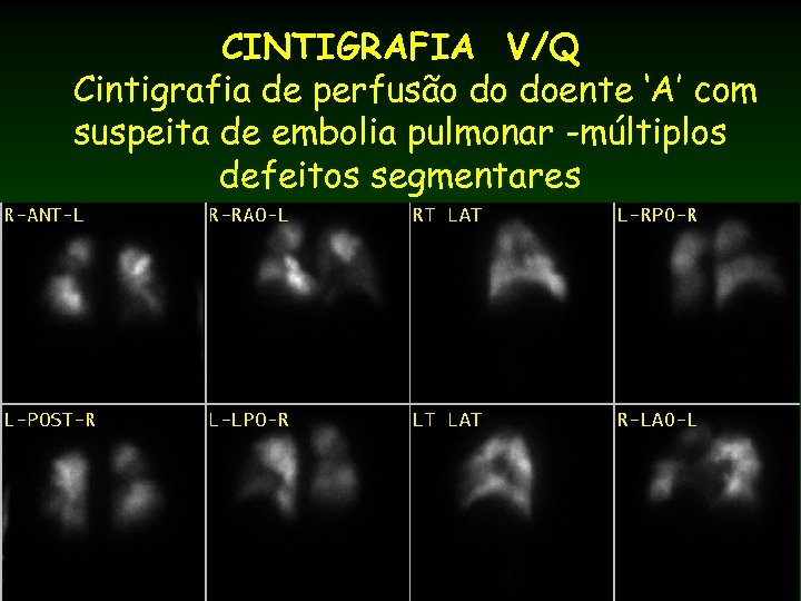 CINTIGRAFIA V/Q Cintigrafia de perfusão do doente ‘A’ com suspeita de embolia pulmonar -múltiplos