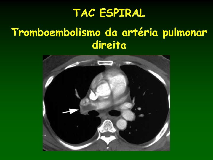TAC ESPIRAL Tromboembolismo da artéria pulmonar direita 