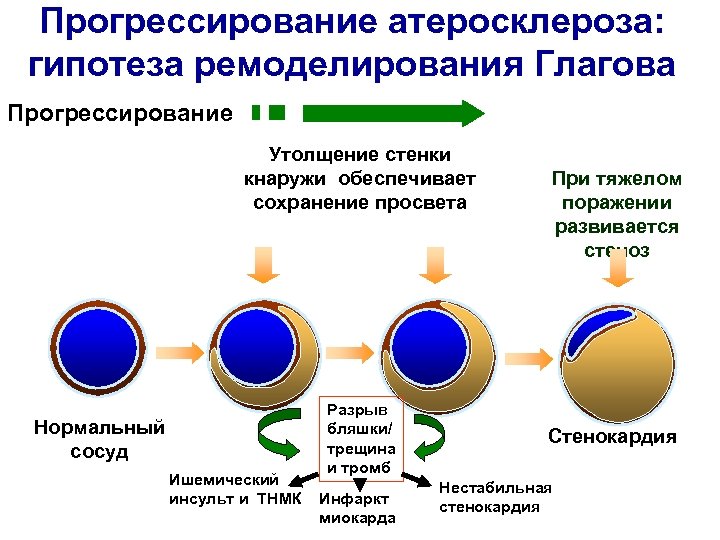 Прогрессирование атеросклероза: гипотеза ремоделирования Глагова Прогрессирование Утолщение стенки кнаружи обеспечивает сохранение просвета Нормальный сосуд