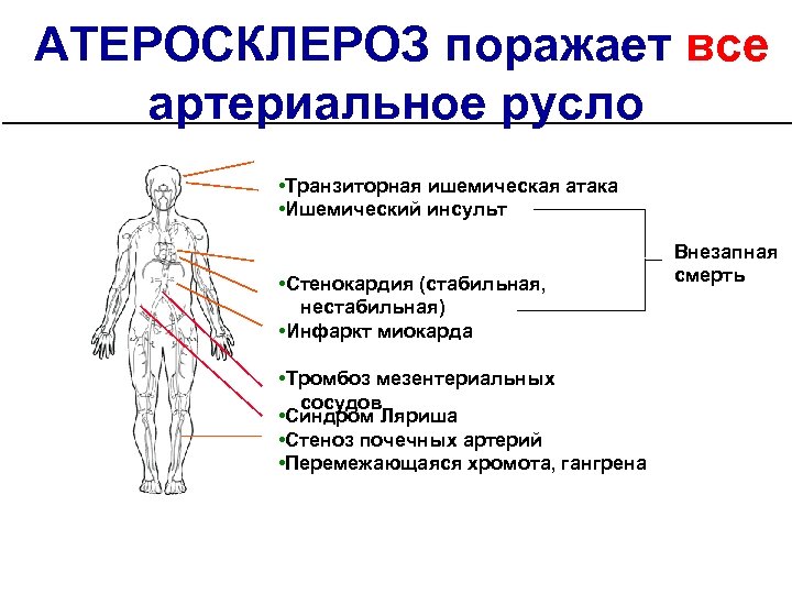 АТЕРОСКЛЕРОЗ поражает все артериальное русло • Транзиторная ишемическая атака • Ишемический инсульт • Стенокардия