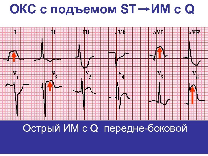 ОКС с подъемом ST ИМ с Q Острый ИМ с Q передне-боковой 