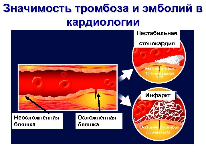 Значимость тромбоза и эмболий в кардиологии Нестабильная стенокардия Инфаркт Неосложненная бляшка Осложненная бляшка 