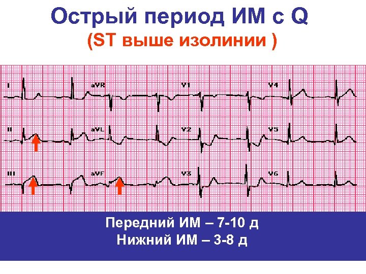 St на изолинии