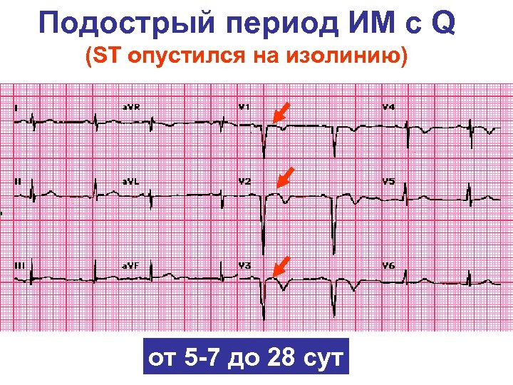 Подострый период ИМ c Q (ST опустился на изолинию) от 5 -7 до 28