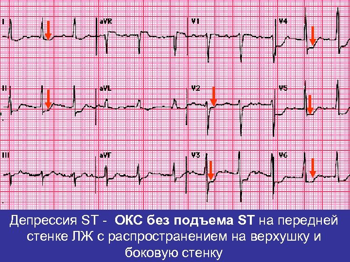 Депрессия ST - ОКС без подъема ST на передней стенке ЛЖ с распространением на