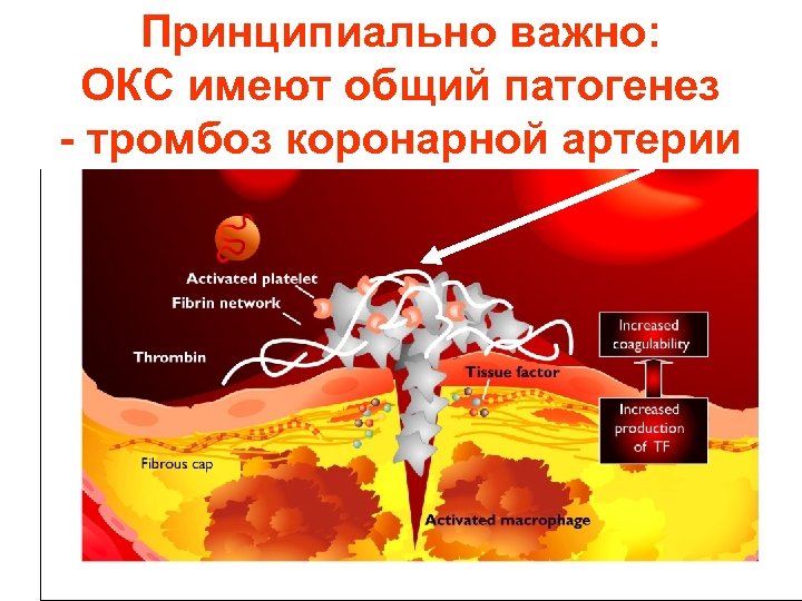Принципиально важно: общий ОКС имеют общий патогенез патогенетический механизм - тромбоз коронарной артерии 