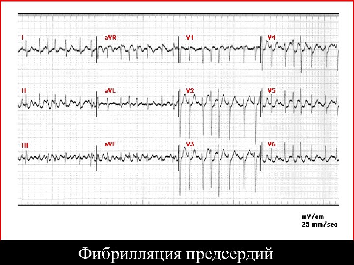 Фибрилляция предсердий 
