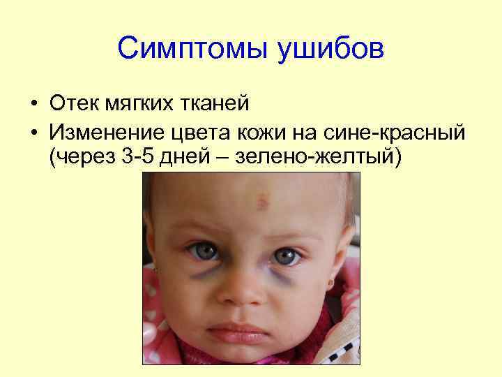 Симптомы ушибов • Отек мягких тканей • Изменение цвета кожи на сине-красный (через 3